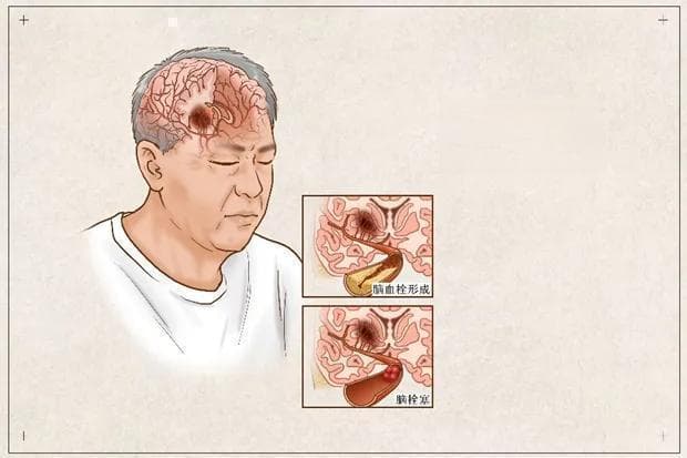 身体"1 软、2 晕、3 多"当心脑梗！这两个识别方法要记牢