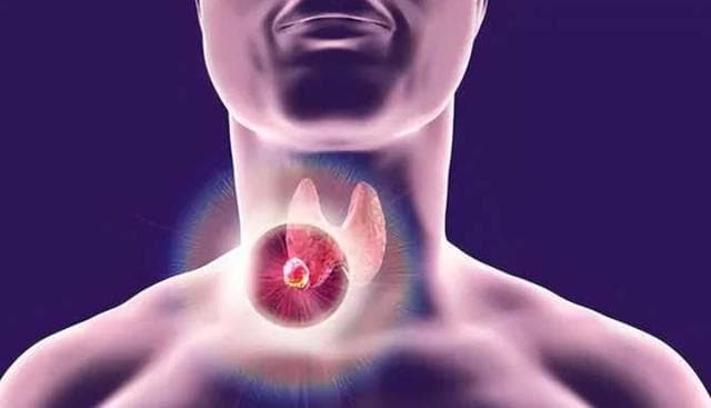 良性结节囊肿息肉的中医调理方案：5味中药助健康