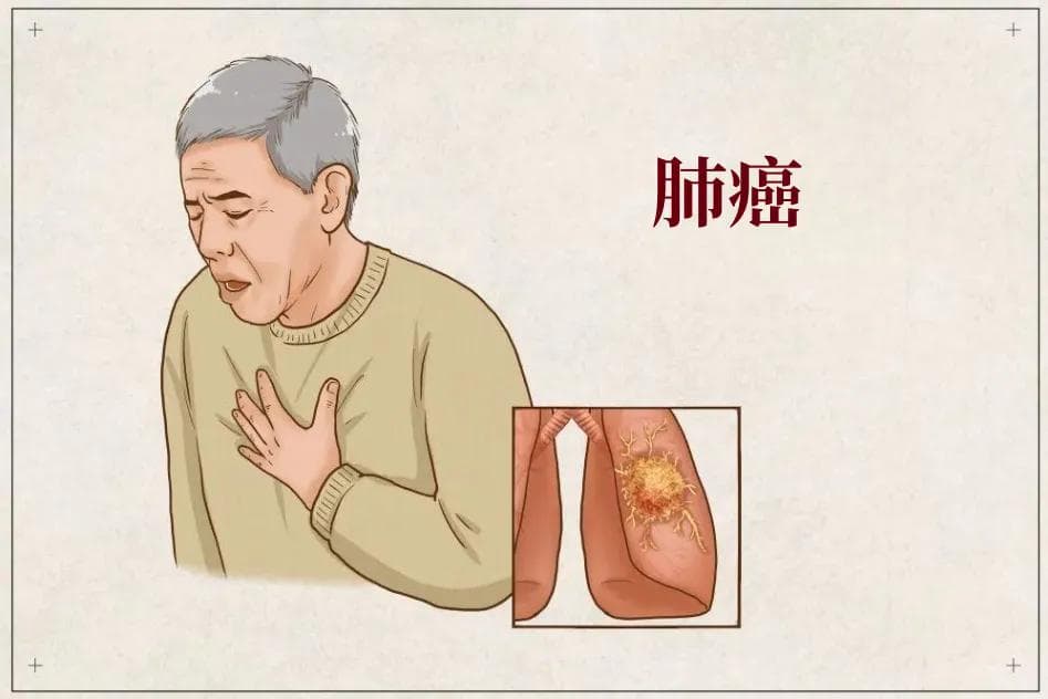 国际肺癌日 | 肺癌早期筛查 出现这几种症状要注意