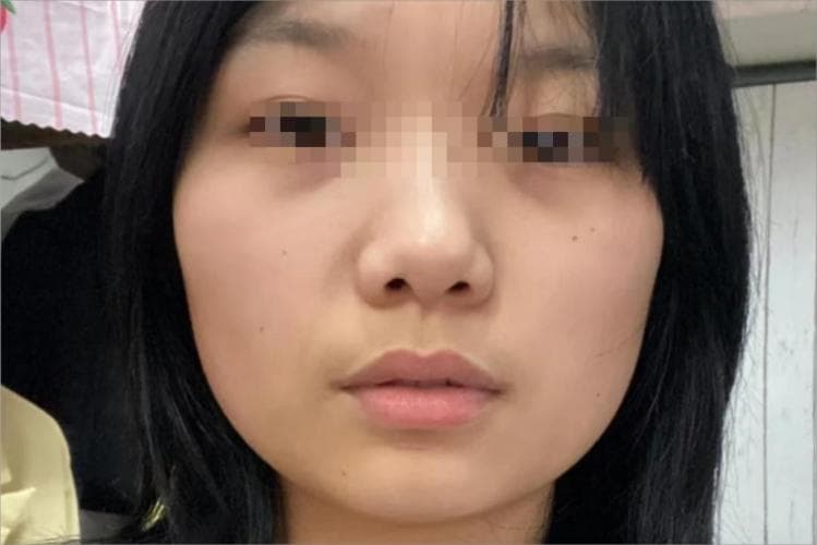 颧骨高突出怎么改善