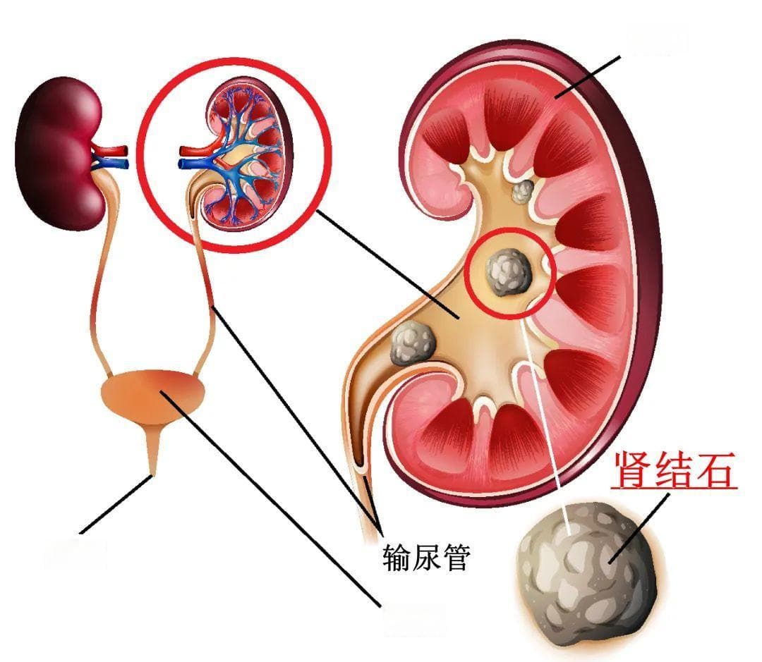 每天喝5升水排出9毫米肾结石？医生：盲目硬扛或致肾衰竭→