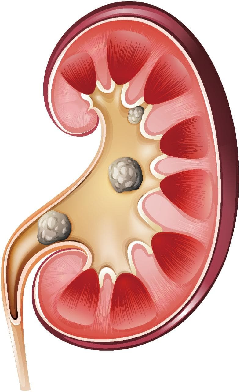 肾结石的成因、症状与预防：一份全面的健康指南