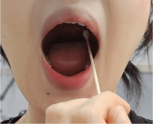 科普|流涎症的康复之路： 从“口水横流”到“滴水不漏”