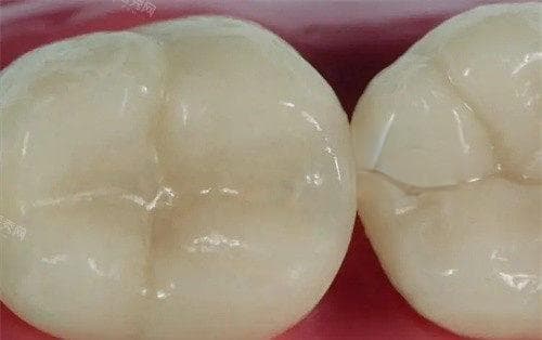牙医提醒：网购补牙剂治牙洞？千万别！
