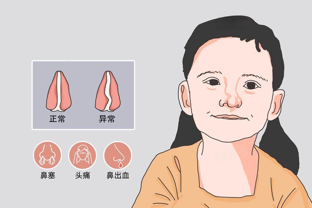 鼻中隔偏曲手术风险大吗
