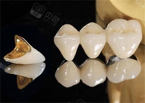 烤瓷牙十几年了怎么拆？从拆除前准备与考量|方法选择|拆除后护理与改善一文全汇总！