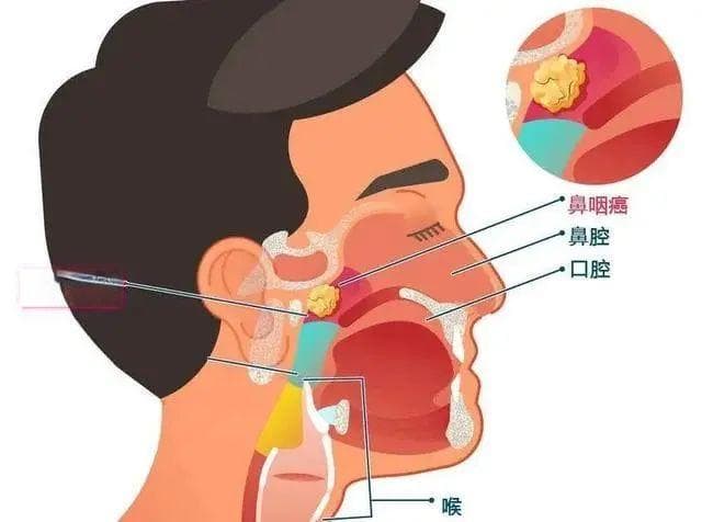 鼻塞2个月一查竟是癌！医生提醒：这些症状易与感冒混淆
