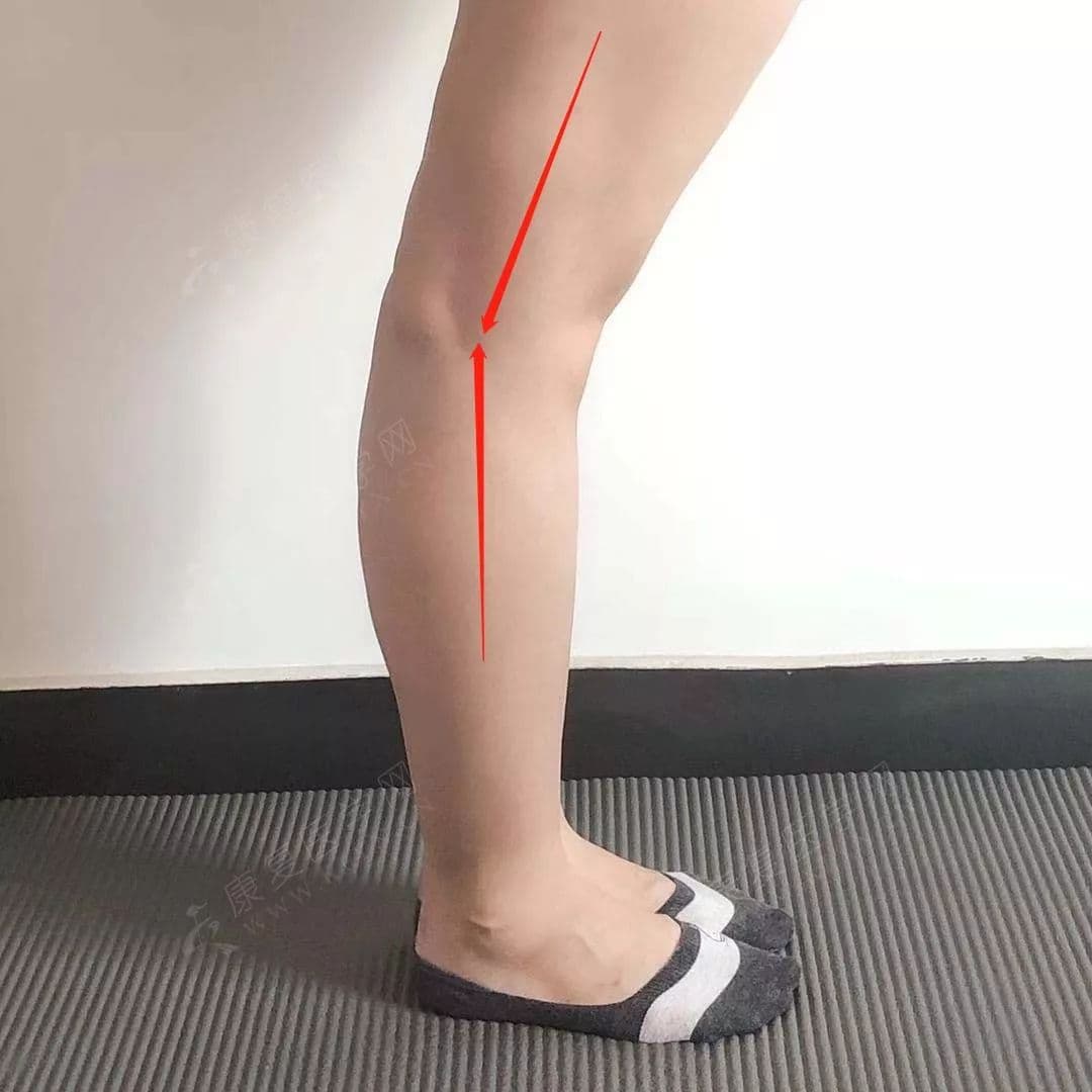 6组动作科学矫正“膝超伸”，1分钟测出你的膝关节是否健康