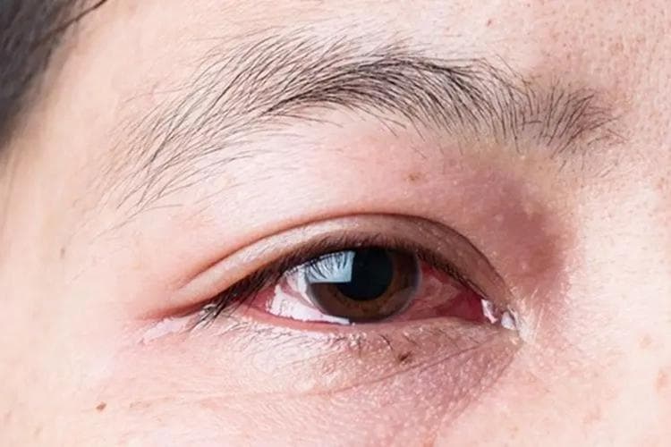 眼睛充血怎么办？四种常见原因及应对方法
