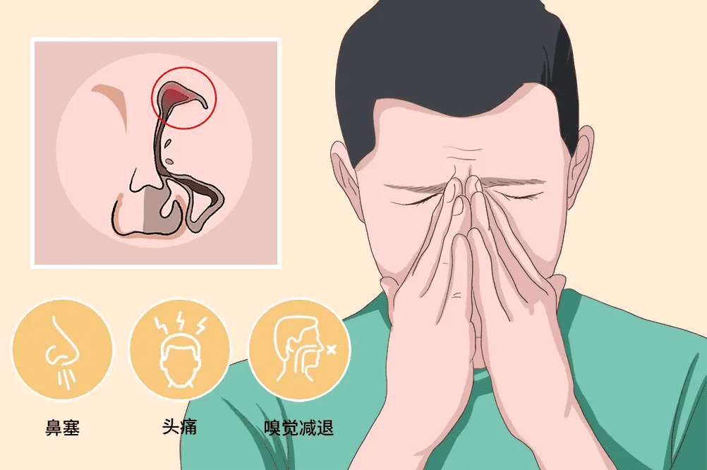 头疼，鼻子不通气……鼻窦炎怎么办？试试这几招