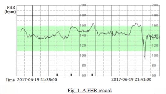 基于胎心仪数据的胎儿心脏诊断神经网络研究