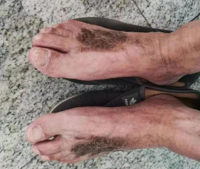 又一批人因为泡脚进了医院，这6种人坚决不要泡脚