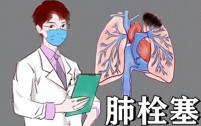 严重肺栓塞，威胁生命！这些风险因素有助于肺栓塞的发生！