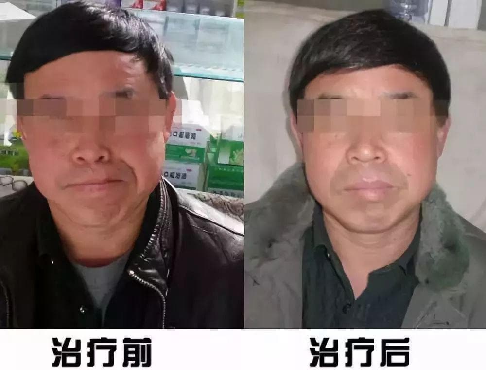 面瘫康复：表情肌康复训练8步法，动图演示
