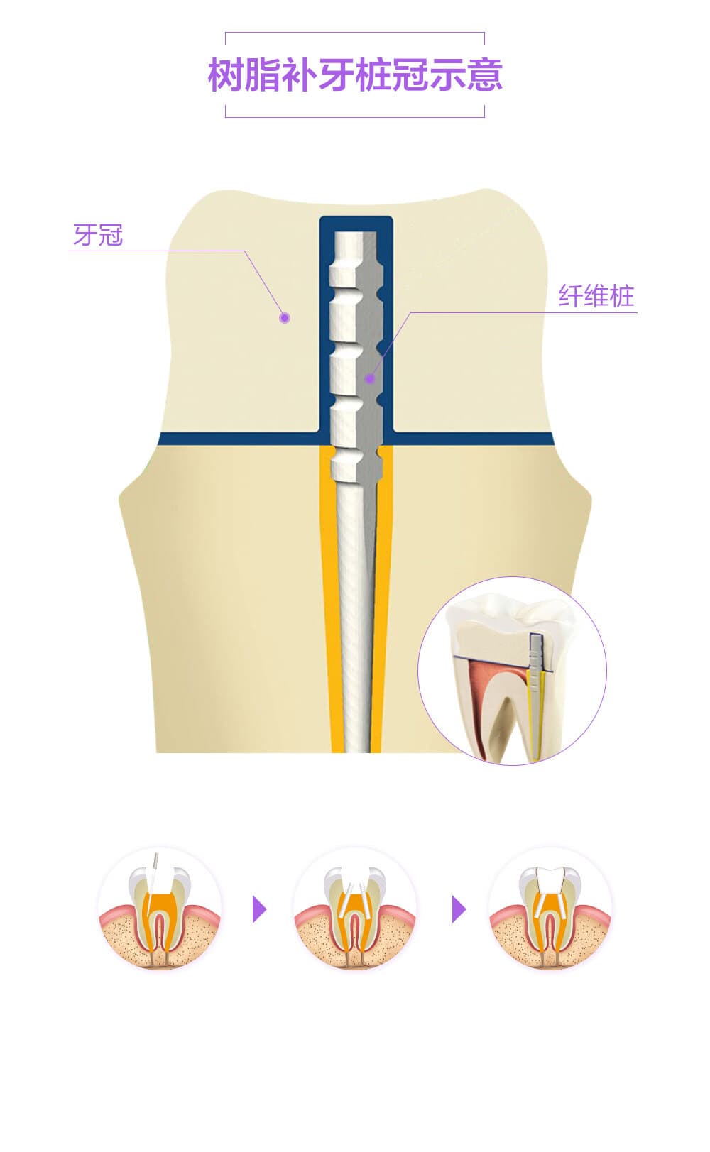 补牙和根管治疗的那些事