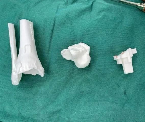 六旬患者脚痛夜不能寐！医院借助3D打印技术实施全踝关节置换术