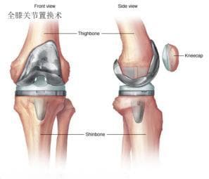 膝关节置换术详解：全膝、单髁与髌股置换手术全过程