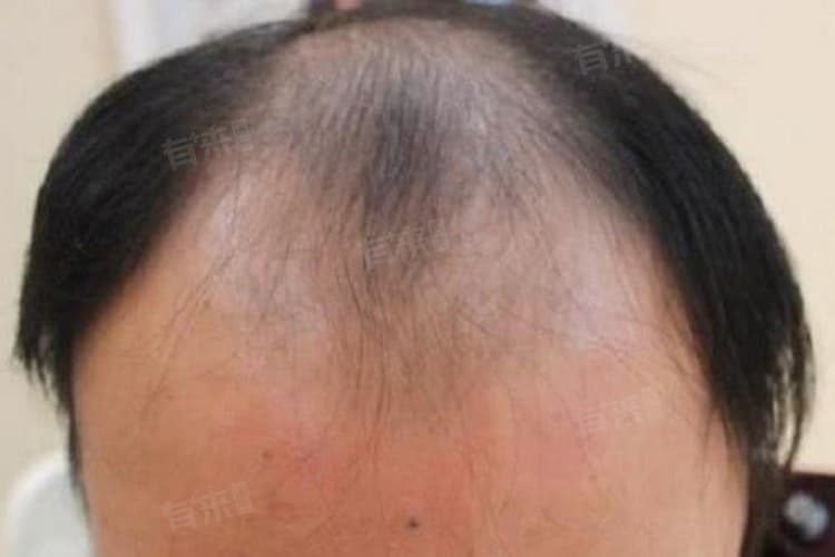 头顶头发稀少是什么原因