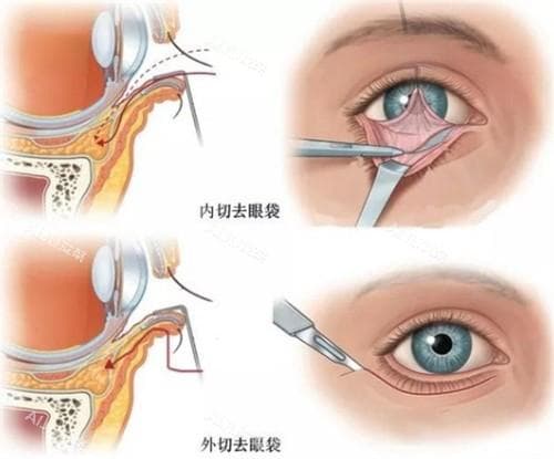 去眼袋哪种方式更加靠谱？怎么选？医生教你按年龄、眼型科学选择