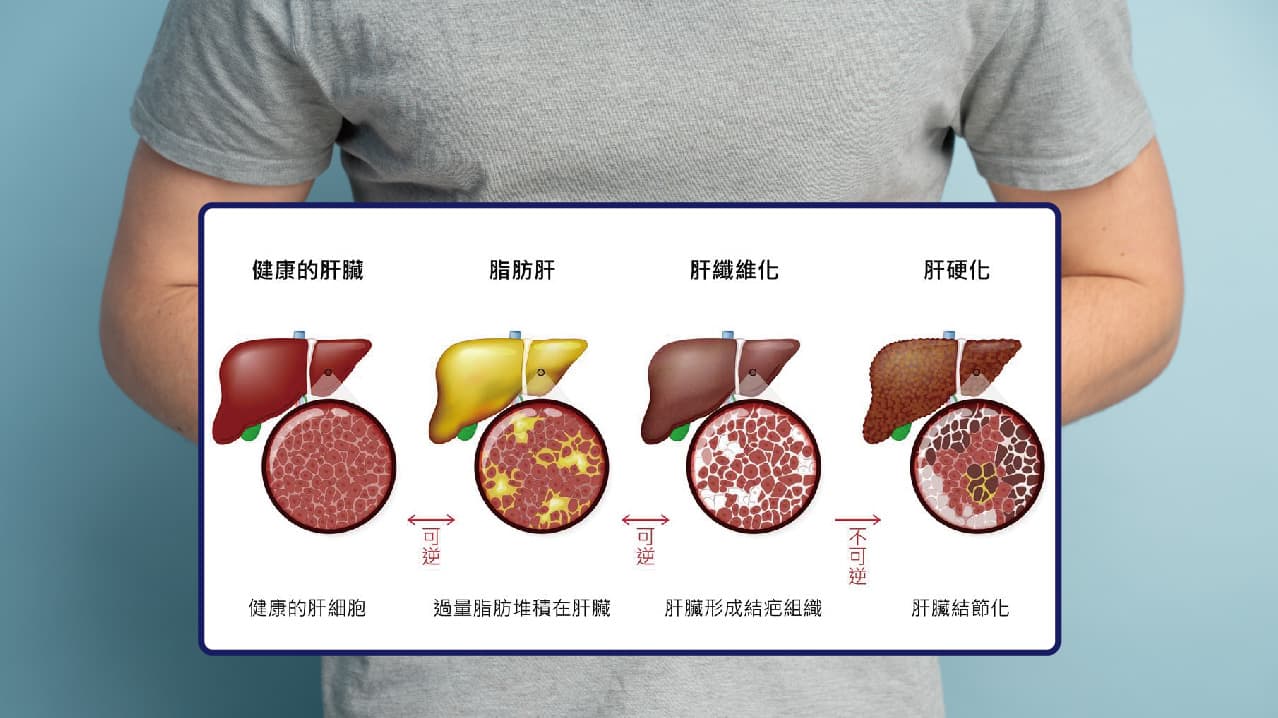 代谢相关脂肪肝病的健康风险