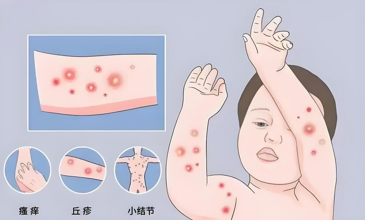 结节性痒疹：揭秘顽固性皮肤病的治疗之道与生活调整策略