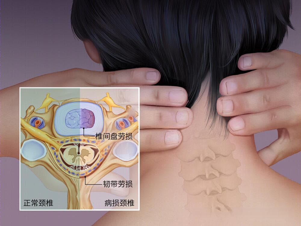 颈肩疼痛、脖子僵？可能是早期颈椎病