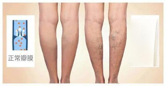腿部静脉曲张不用怕！自我恢复办法
