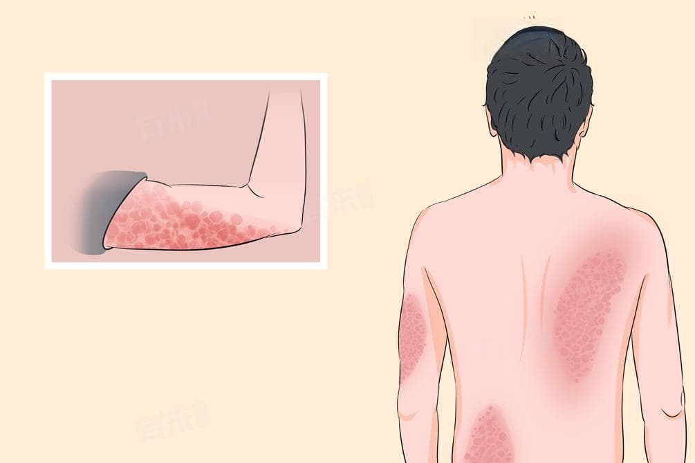 硬皮病怎么治？治疗后有哪些后遗症？