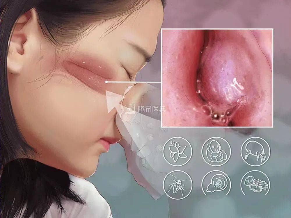 【朝医科普】过敏性鼻炎认识与防护