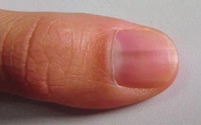 指甲有竖纹、黑线，是身体在预警？一次说清指甲 5 大真相