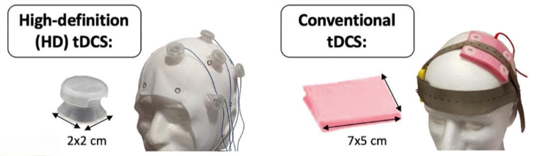 tDCS：一种潜在的治疗抑郁症的有效方式