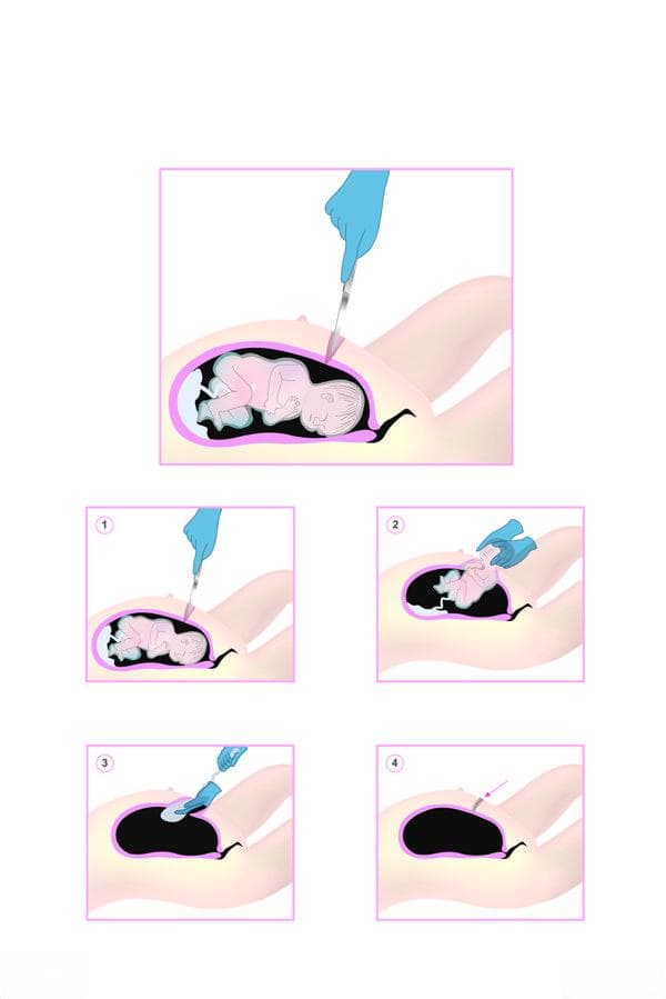 剖腹产粘连如何查出