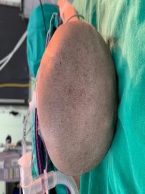 颅缝早闭症：一种影响婴儿头骨发育的疾病