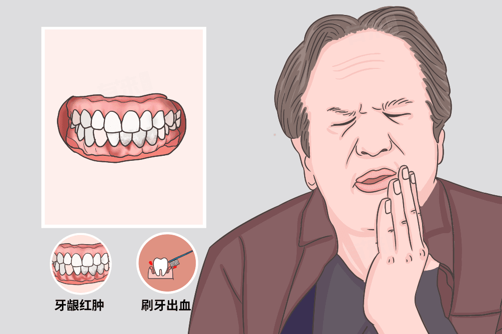 牙龈炎治得好吗