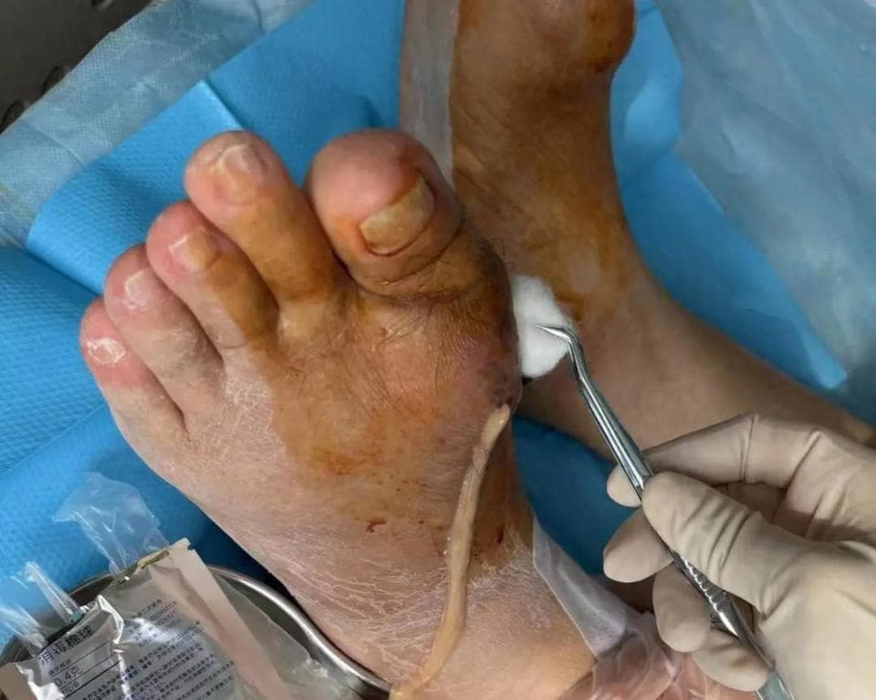 有了痛风石不知道怎么处理？聪明人都是这样做，你会吗？