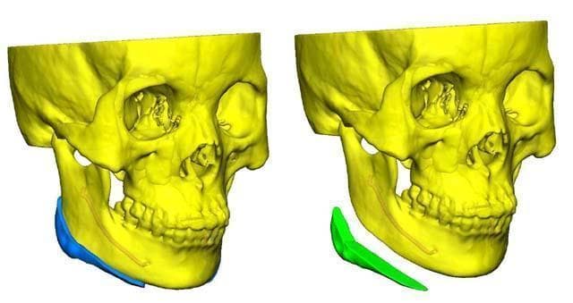 胡一刀：浅谈面部轮廓整形与3D打印技术