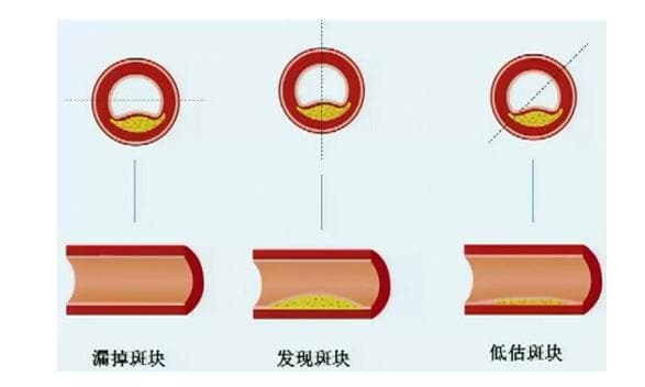 牢记三要诀，轻松看懂冠脉CTA