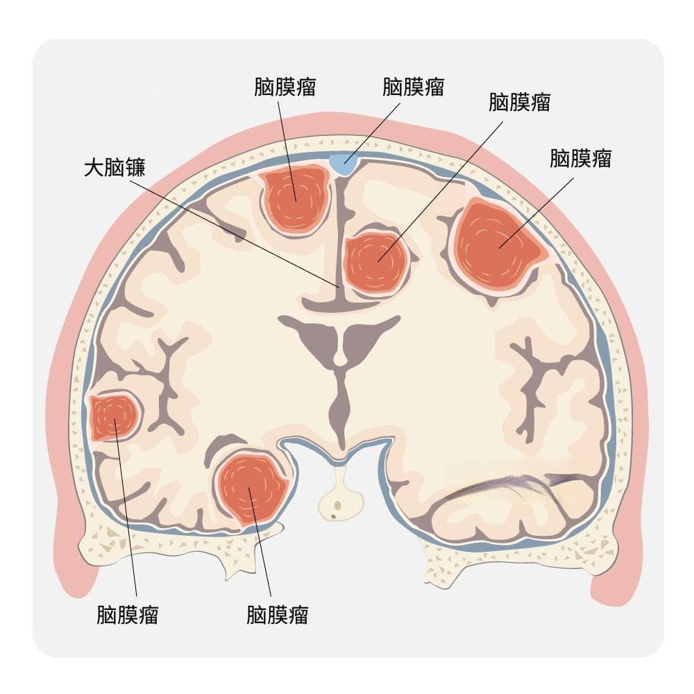 矢状窦旁脑膜瘤的显微手术治疗策略