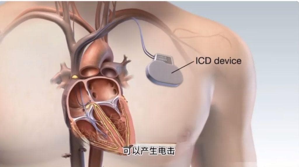 守护心跳的“隐形卫士”——ICD（植入式心律转复除颤器）