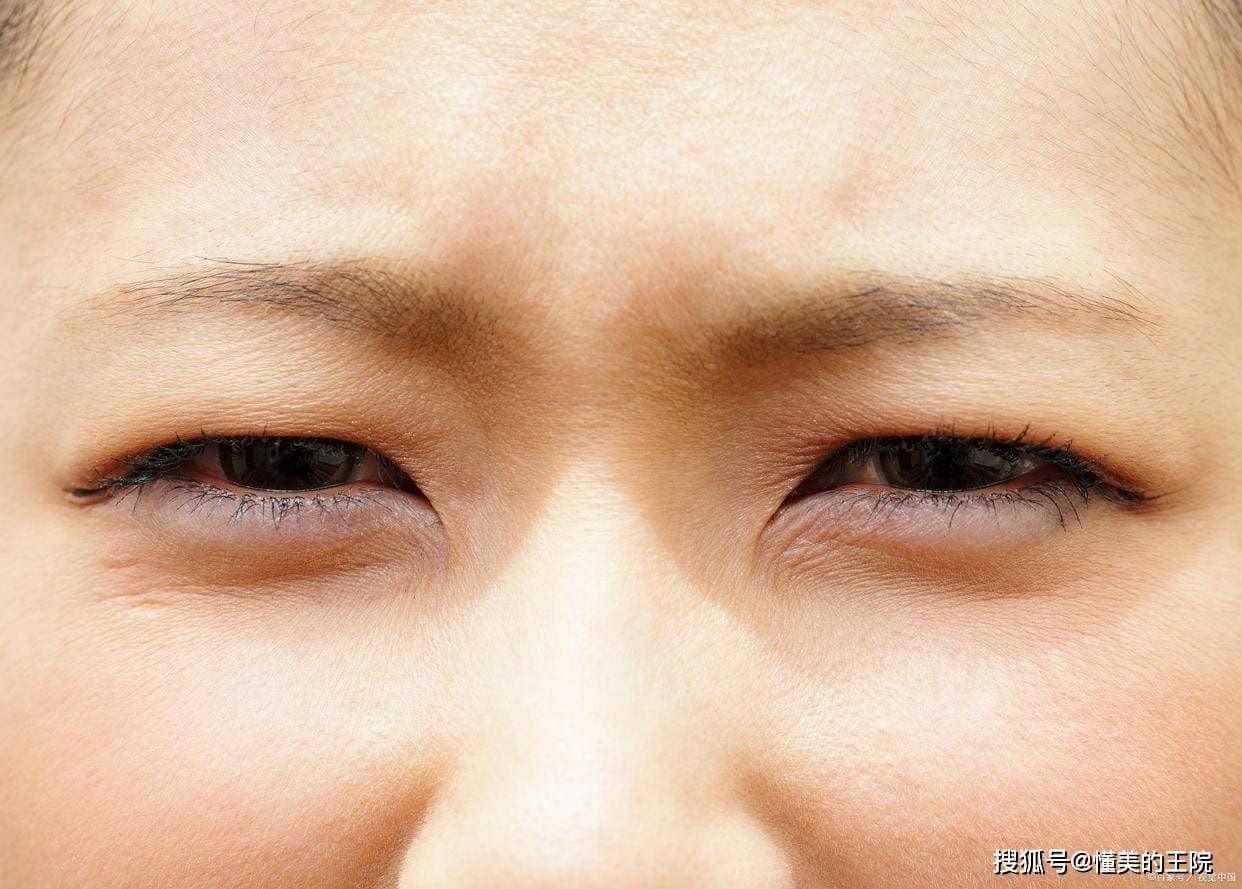 后天性上睑下垂的分类与解析