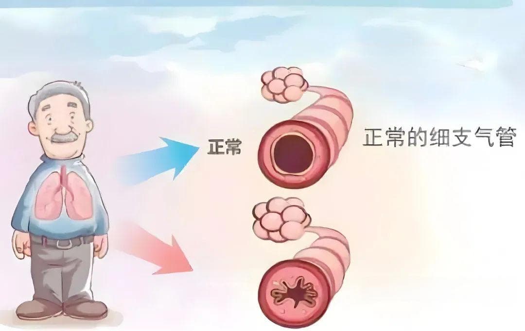 【科普】科学防“废”：慢阻肺患者的养肺妙招