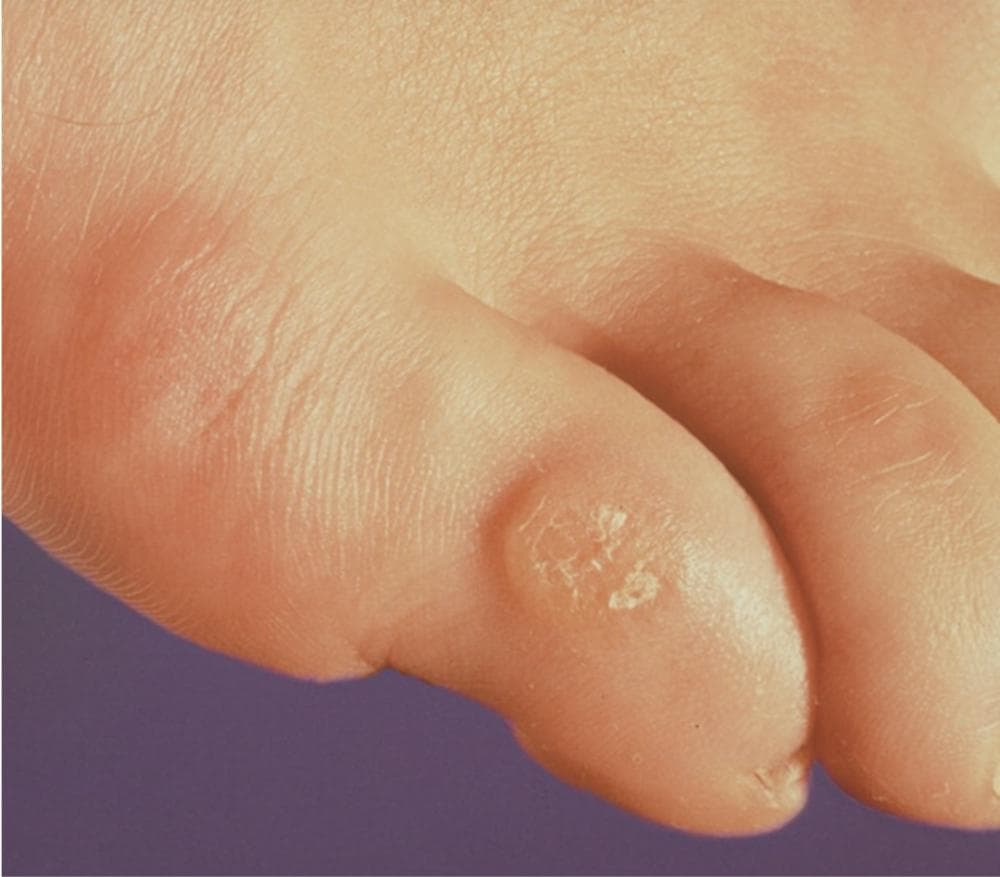 脚上长了小硬块，千万别弄混！这样才是感染了HPV——