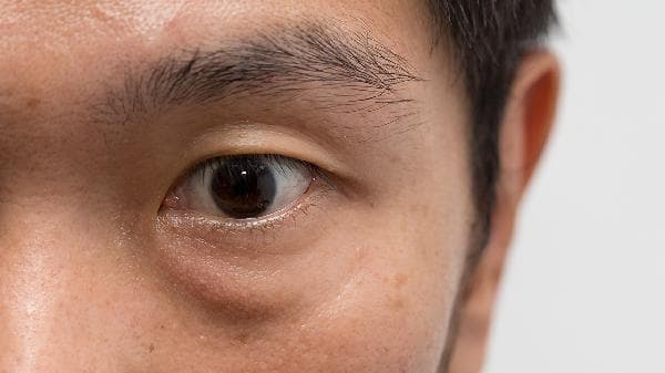 眼袋手术风险全解析：从感染到不对称，这些要点需谨记