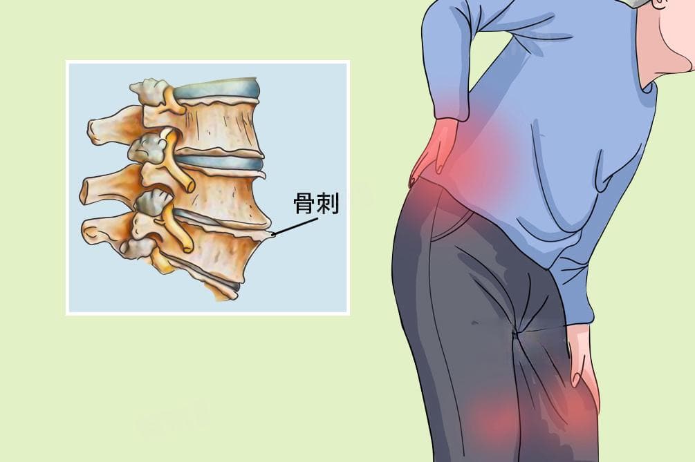 腰骨质增生怎么治疗