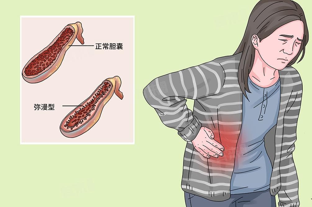 胆囊腺肌症的形成原因及注意事项