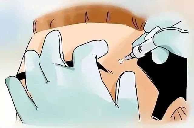 痣太多？突然长出很多痣？猜你想问→