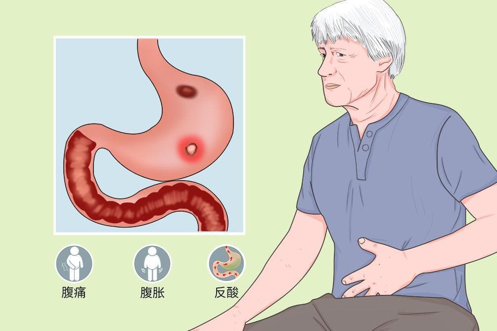 胃黄色素瘤不是癌，内镜下治疗可根除