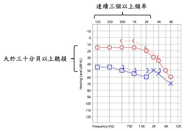 认识突发性耳聋：症状、成因与治疗