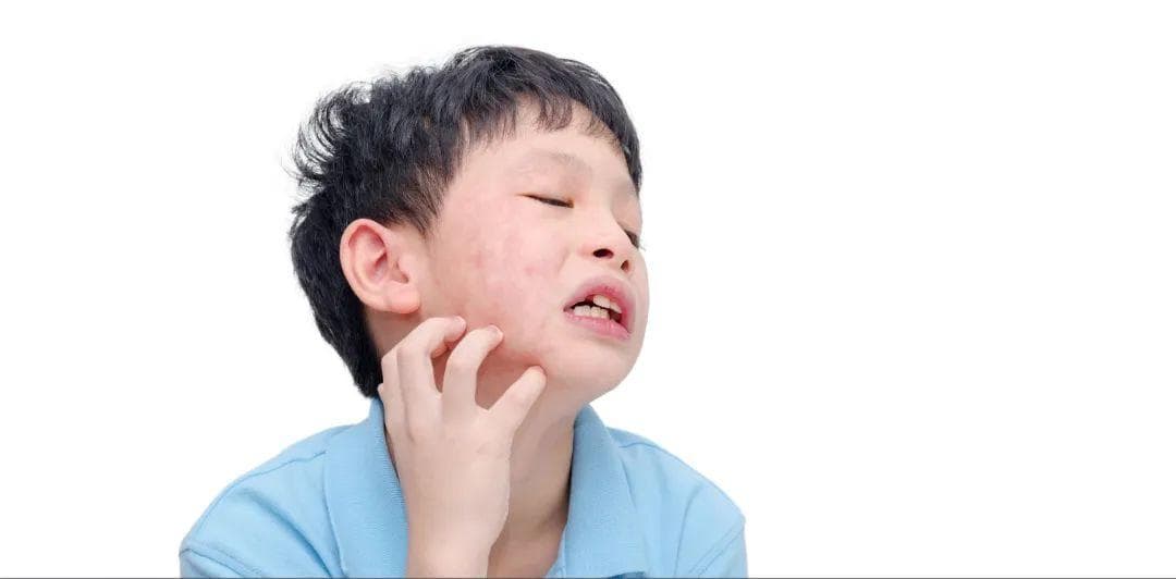 孩子突发重度食物过敏可危及生命，关键急救方法收藏起来有备无患