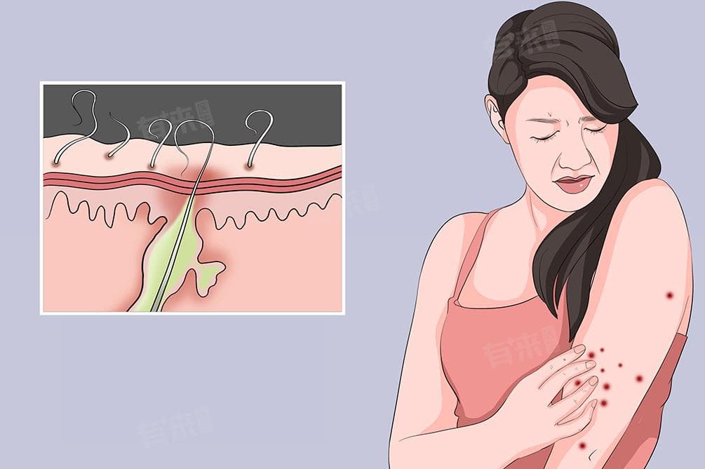 毛囊炎是真菌感染还是细菌感染